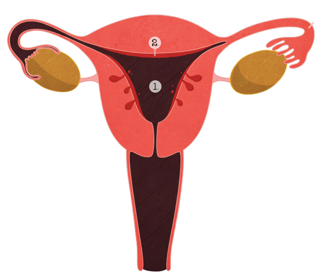 Interno_endometriosi